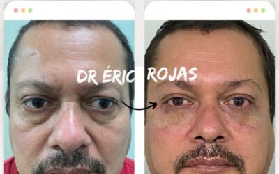 Contamos con el mejor tratamiento para tus ojeras y rejuvenecer tu rostro.