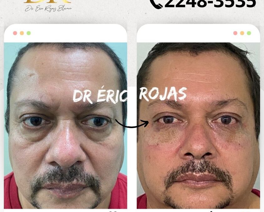 Contamos con el mejor tratamiento para tus ojeras y rejuvenecer tu rostro.
