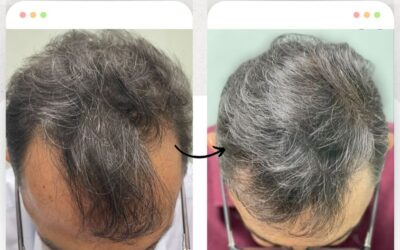 Trata tu alopecia, nosotros somos su solución.