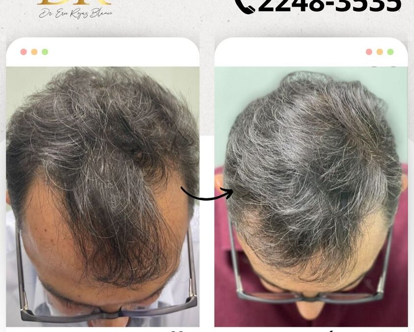 Trata tu alopecia, nosotros somos su solución.