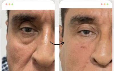¿Deseas eliminar tus ojeras?, tenemos la solución.