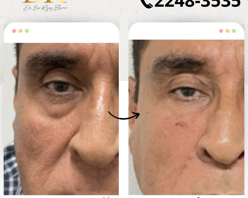 ¿Deseas eliminar tus ojeras?, tenemos la solución.