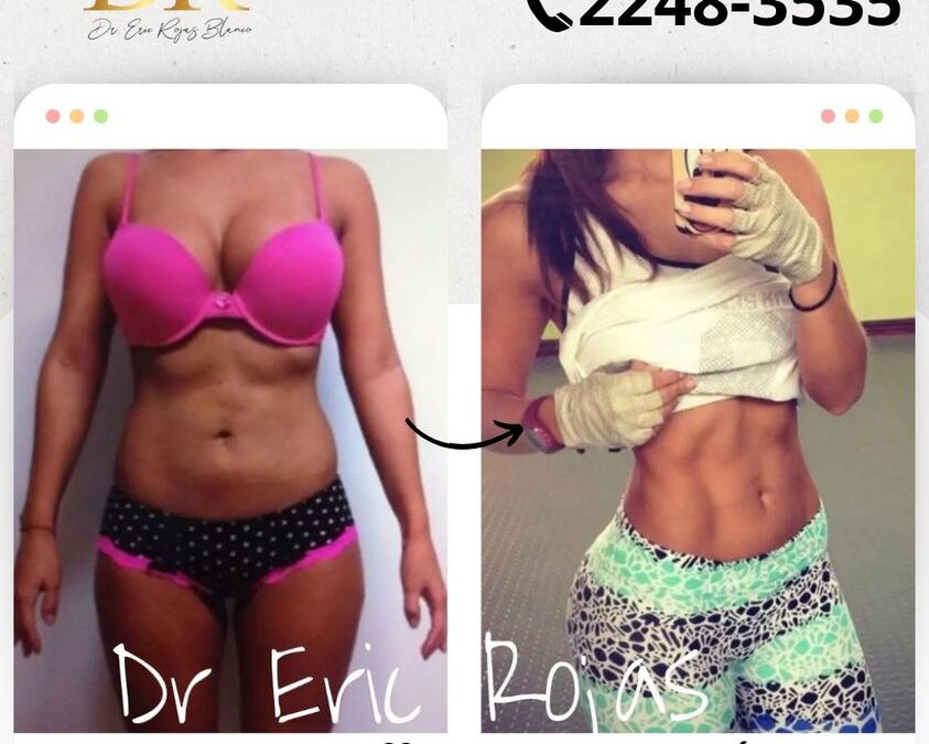 Slim Láser Abdomen.