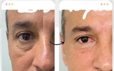 Rejuvenece tu rostro con las mejores técnicas.