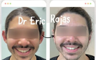 Dermo Otoplastía.