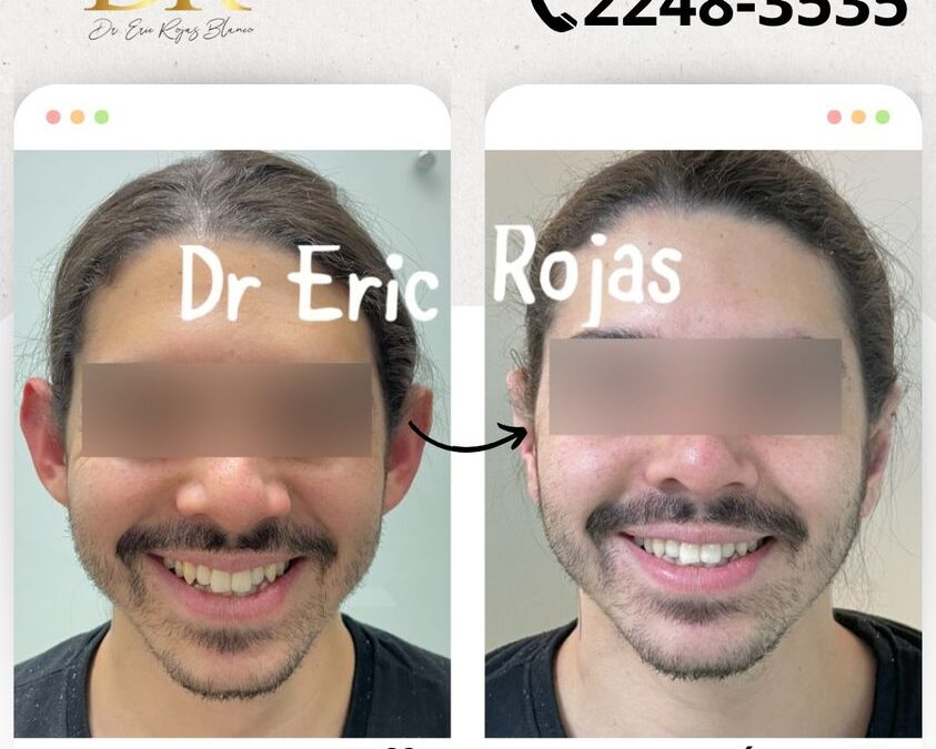 Dermo Otoplastía.