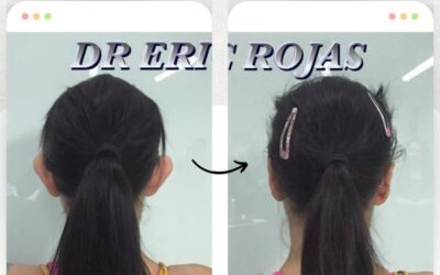 Dermo otoplastía en promoción por el mes de la patría. $950 USD.