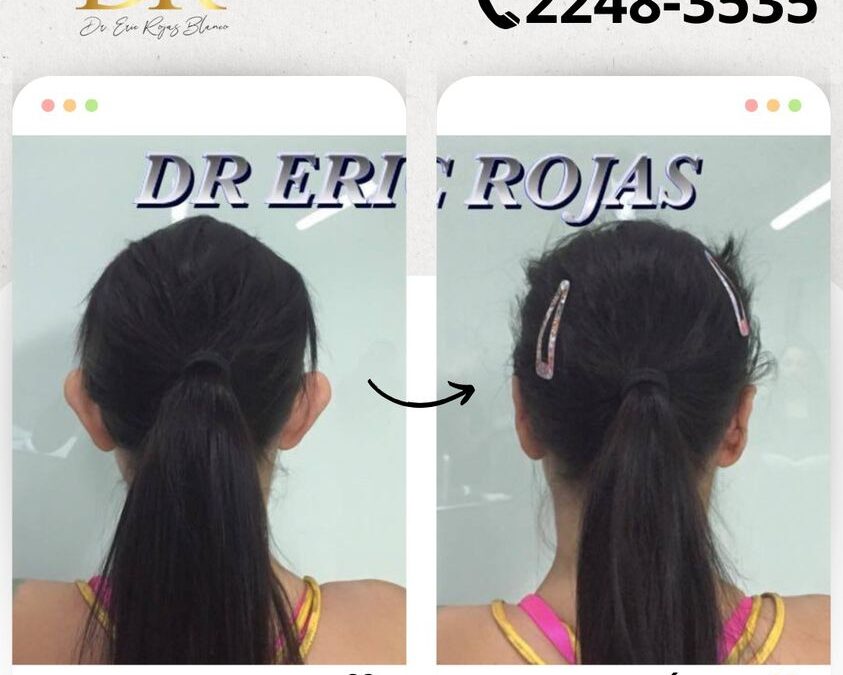 Dermo otoplastía en promoción por el mes de la patría. $950 USD.
