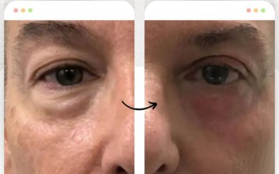 Rejuvenece tu rostro y elimina las ojeras.
