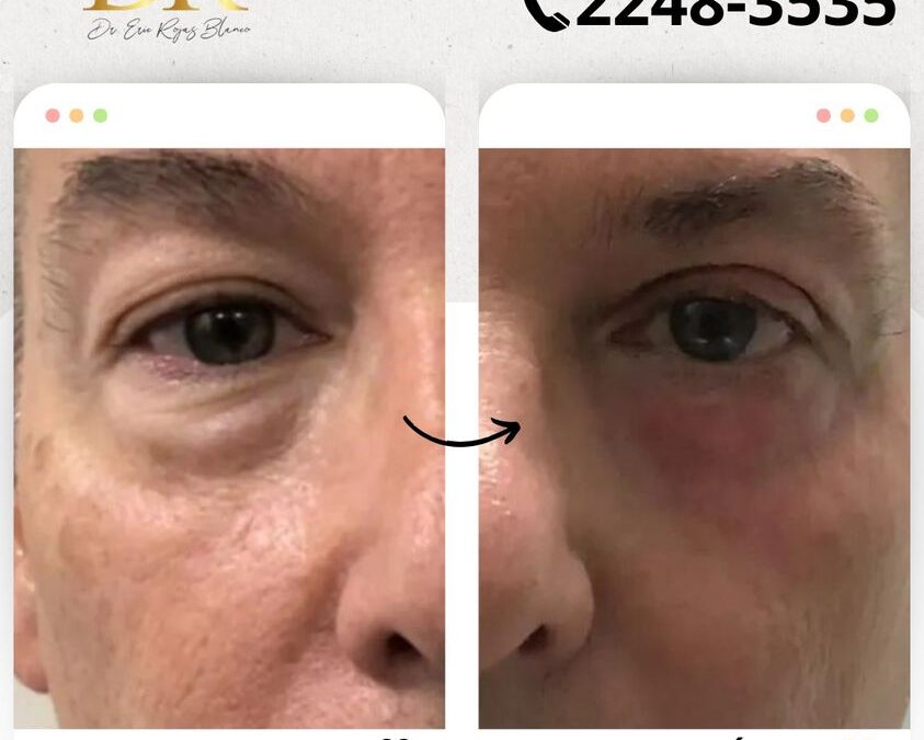 Rejuvenece tu rostro y elimina las ojeras.