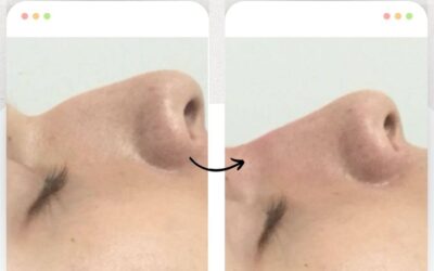 Rinolift es el mejor procedimiento para mejorar el perfil de tu nariz.