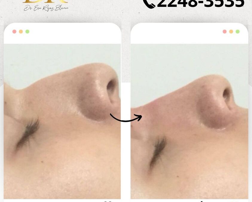 Rinolift es el mejor procedimiento para mejorar el perfil de tu nariz.