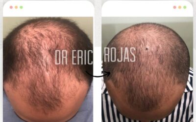 En el primer mes notas grandes avances con tu alopecia.