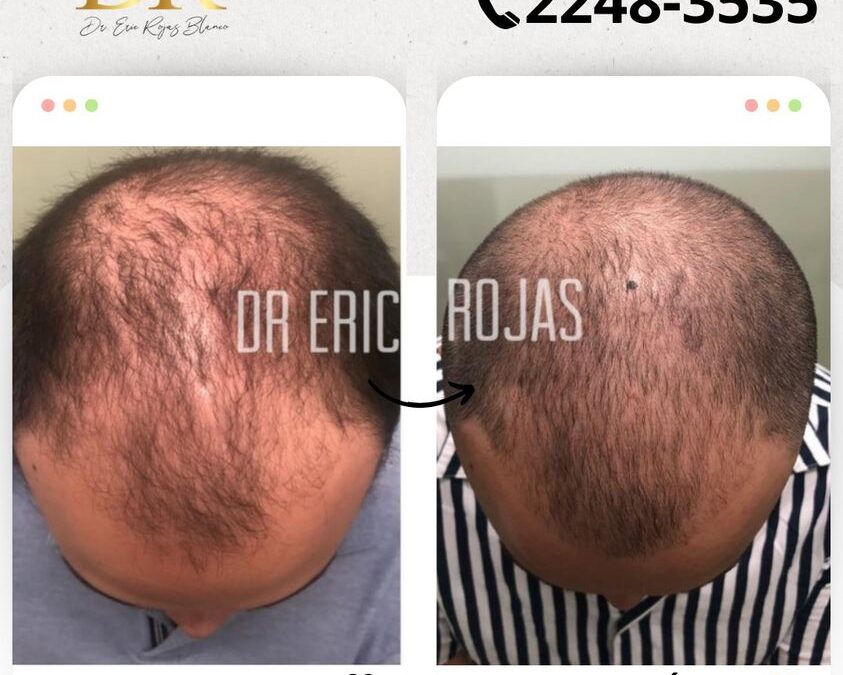 En el primer mes notas grandes avances con tu alopecia.