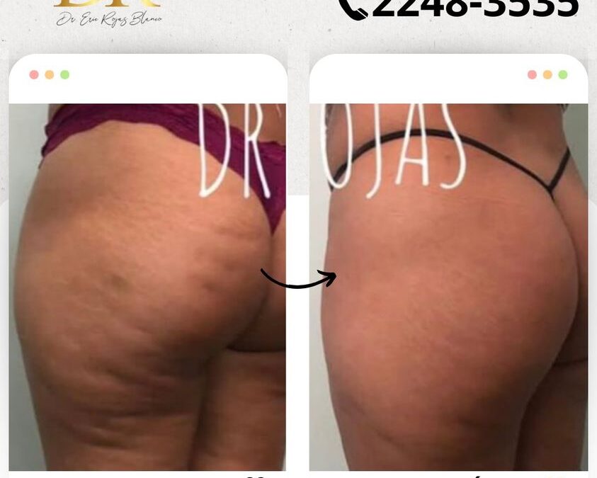 Elimina la celulitis de tu vida con los mejores procedimientos