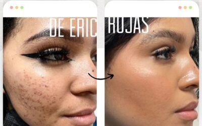 ¿Tu rostro tiene acné?, podemos ayudarte y limpiar tu rostro.