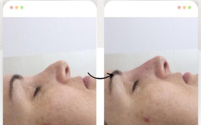 Rinolift, el procedimiento ideal para corregir tu nariz.