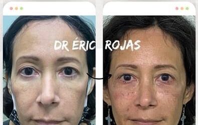 Rejuvenece tu rostro con la mejor técnica en nuestro clínica.