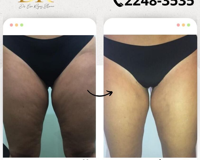 Elimina la celulitis de tu piel.