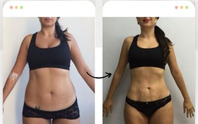 Increíbles cambios con Slim Láser.