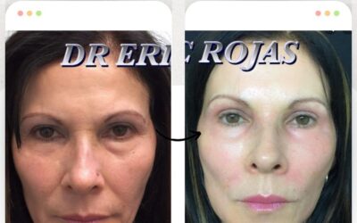 Rejuvenece tu rostro con las mejores técnicas.