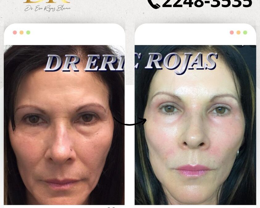 Rejuvenece tu rostro con las mejores técnicas.