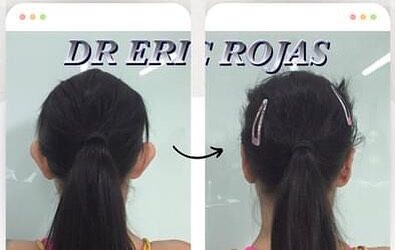 Dermo otoplastía en promoción por el mes de la patría. $950 USD