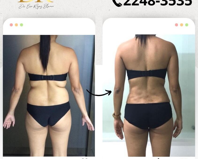 Resultados asombrosos con Slim Láser.