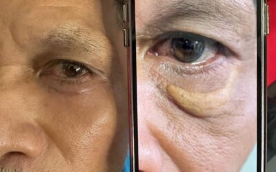 Cambiamos vidas, mira la gran diferencia que tiene nuestro paciente en su ojo