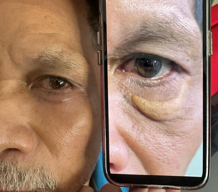 Cambiamos vidas, mira la gran diferencia que tiene nuestro paciente en su ojo
