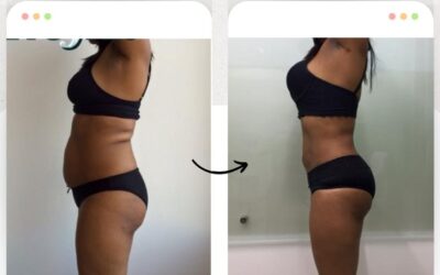 Cambios realmente increíbles logrados con Slim Láser.