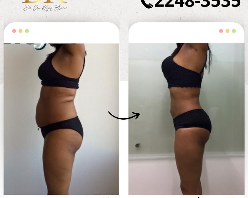 Cambios realmente increíbles logrados con Slim Láser.