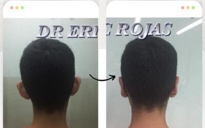 Dermo otoplastía por solo $950 dólares