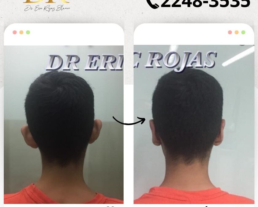 Dermo otoplastía por solo $950 dólares