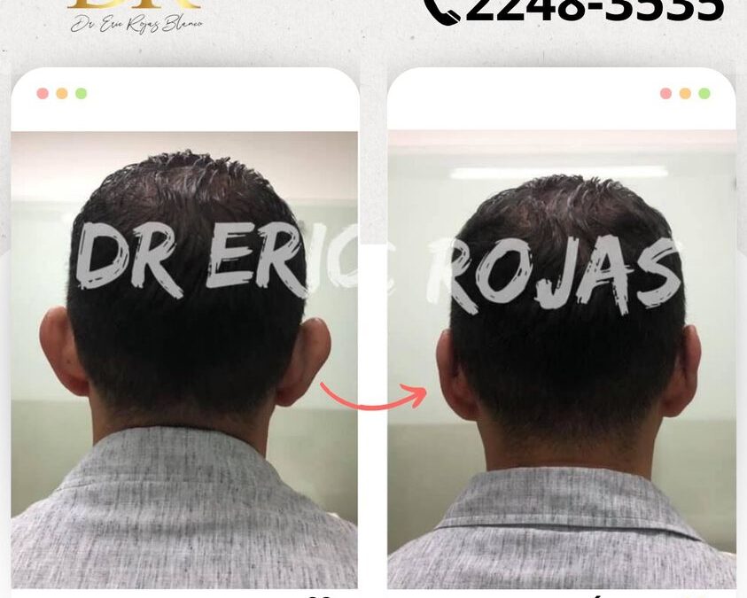 Corrección de orejas, con la mejor técnica.