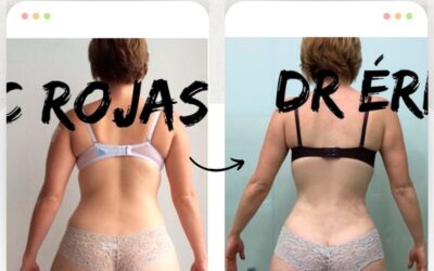 Mira los increíbles resultados del Slim Láser en nuestra paciente, ¿Qué te pareció el cambio? 👇