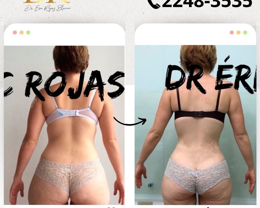 Mira los increíbles resultados del Slim Láser en nuestra paciente, ¿Qué te pareció el cambio? 👇