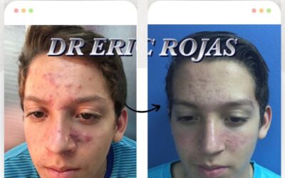 Tratamiento Garantizado para eliminar el acné de tu vida.