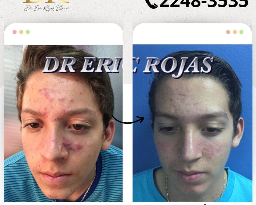 Tratamiento Garantizado para eliminar el acné de tu vida.