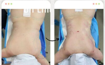 Slim Láser con resultados impresionantes.