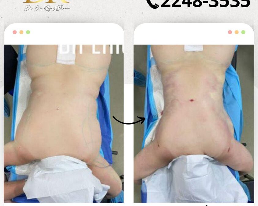 Slim Láser con resultados impresionantes.