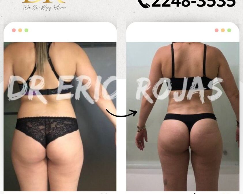 Slim Láser genera resultados impresionantes.