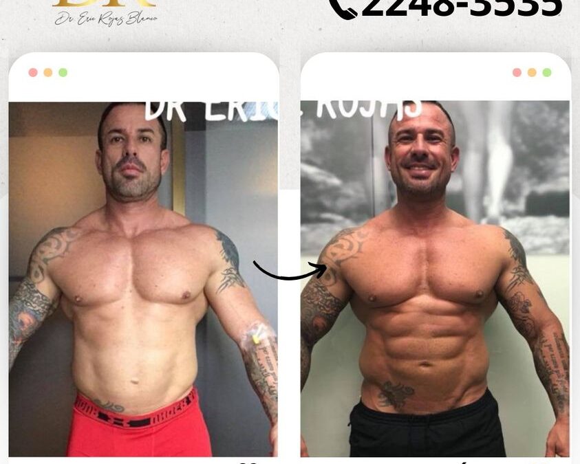 Marcaje abdominal con Slim Láser.