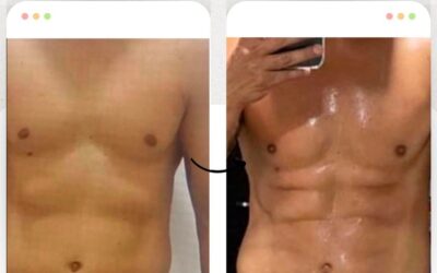 Marcaje abdominal con Slim Láser. 🆒