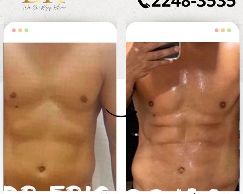 Marcaje abdominal con Slim Láser. 🆒