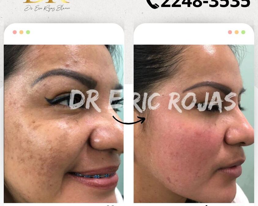 Limpia tu rostro de las manchas.