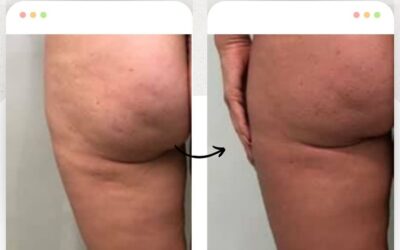 Contamos con la mejor herramienta para eliminar la celulitis.