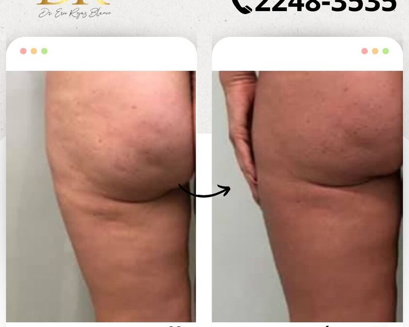 Contamos con la mejor herramienta para eliminar la celulitis.