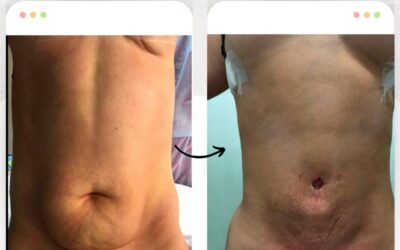 Mira los increíbles resultados del Slim Laser, ¿Qué te pareció el resultado? 👇