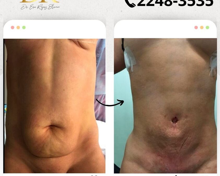 Mira los increíbles resultados del Slim Laser, ¿Qué te pareció el resultado? 👇